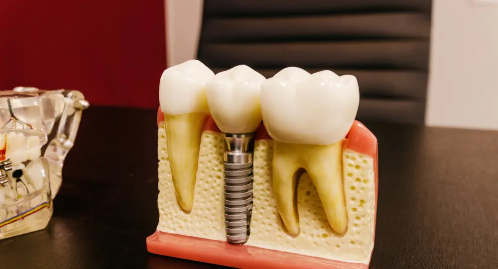 Tratamento de Implante Dental em Cuiabá - Instituto Carvalho